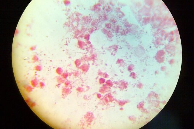 1779358261_Neisseria-Gonorrhea.jpg