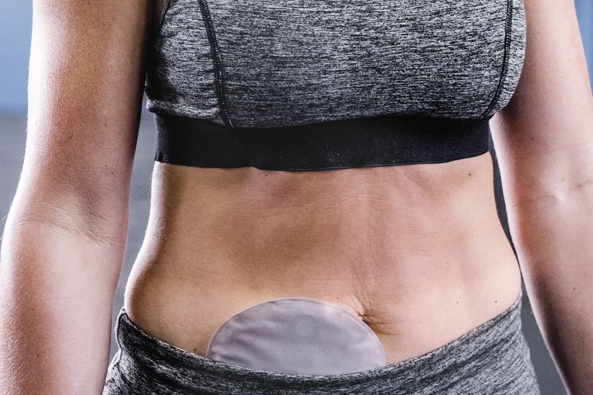 អត្តពលិកស្រីដែលមានកាបូប ostomy ឈរនៅកន្លែងហាត់ប្រាណ