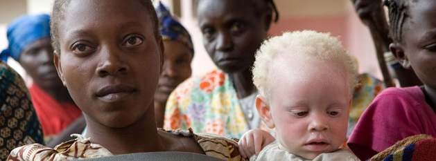 1780505037_albinism.jpg