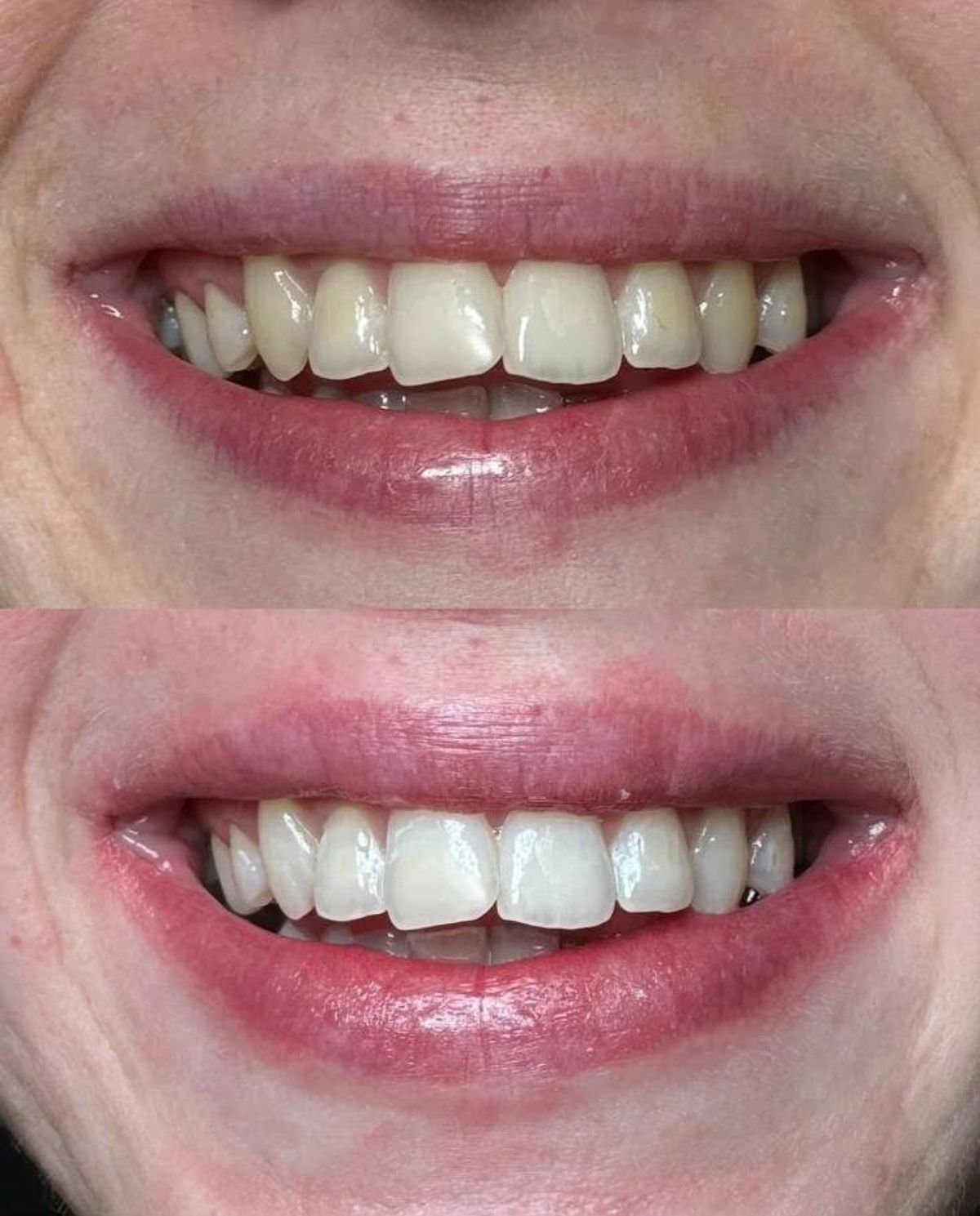 នរណាម្នាក់ឈានដល់សម្រាប់ HeySmile Teeth Whitening Strips