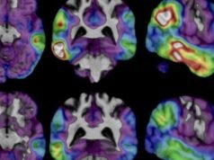 ថ្នាំ Alzheimer ពិសោធន៍ថ្មីបង្ហាញពីសក្តានុពលបន្ទាប់ពីការសិក្សាបង្ហាញពីការថយចុះនៃការយល់ដឹង